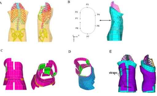 Figure 4.2 Article 2 Figure 2 A- Finite element model (FEM) of the trunk;  B - Generative  curves;  C- Geometrical model of the brace; D- FEM of the brace; E- Brace installed on the  patient 