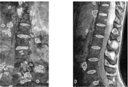 Figure 2-5: Imagerie de la colonne par résonnance magnétique. Vue frontale à gauche et vue  sagittal à droite