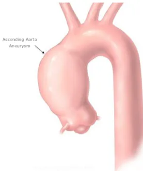 Figure 2.2: A typical example of an ascending aorta aneurysm is shown in the image. The dia- dia-meter suddenly changes after the aortic root, causing the jet to behave abnormally