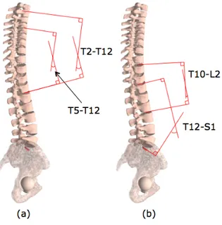 Figure 1-9 : Mesure des déformations dans le plan sagittal : (a) cyphose, (b) lordose  Vertèbre apicale 