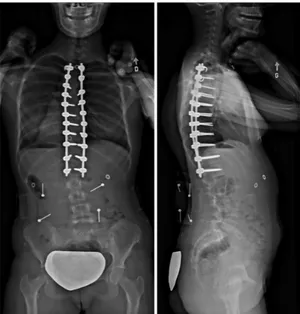 Figure 1-15 : Radiographies post-opératoires d’un patient scoliotique suite à l’instrumentation du rachis (issue d’une  banque d’images de l’auteur) 