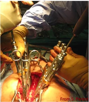 Figure 1-16 : Champ visuel pendant la chirurgie par approche postérieure 