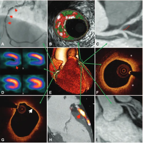 Figure 5. Multimodal approach to atherosclerosis imaging. A representative illustration of current 