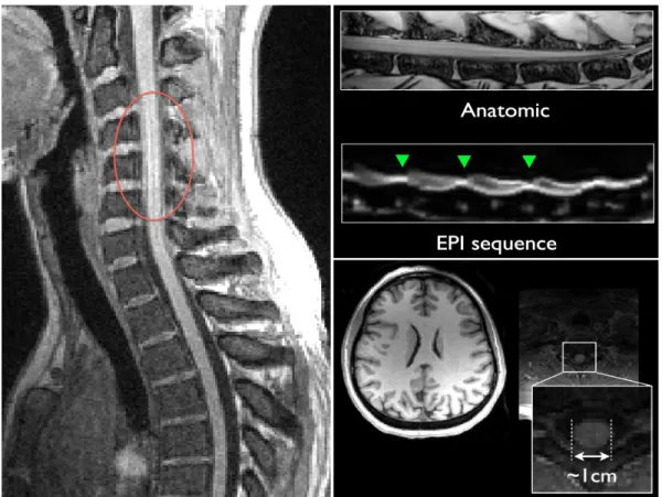 Figure 2.6 : Imager la moelle épinière est un challenge. Quelques exemples d’artefacts dans les  images de moelle épinière : les mouvements de flux de LCS (à gauche), les différences de  susceptibilité magnétique entre les tissus à leur interface, pour des