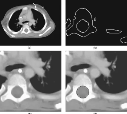 Figure 2.8 : Processus de détection du canal spinal développé par Rangayyan et al., 2006
