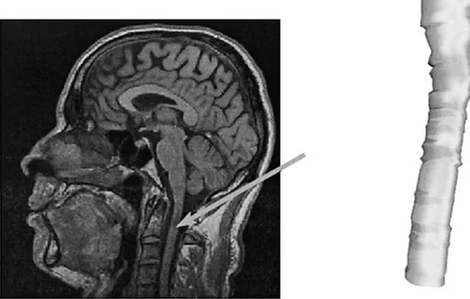 Figure 2.10 : Segmentation de la moelle épinière sur une image IRM pondérée en T 1  grâce à la 