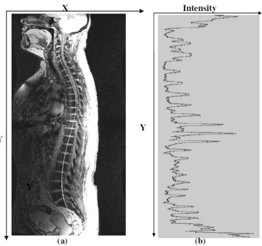 Figure 2.13 : (gauche) Ajustement de polynôme après la détection des disques intervertébraux