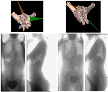 Figure 1.16: Vues transversale, coronale et sagittale de deux patients de types Lenke 1 (Labelle, 2011).