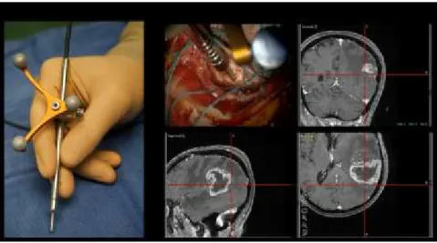 Figure 4.1 : Raman spectroscopy system for intraoperative detection (A) Photograph of the hand- hand-held contact probe, with the attached tracking unit