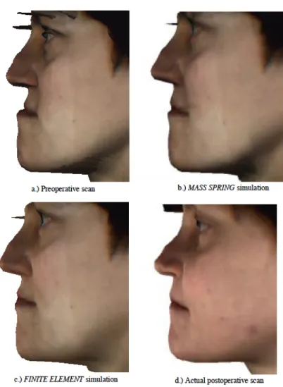 Figure 1.8 : Résultats d’une simulation de chirurgie maxillo-faciale utilisant la MMR et  la MEF, tiré de (Keeve, Girod, &amp; Girod, 1996) 