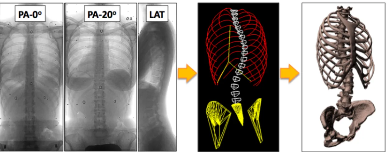 Figure 3.2 : Étapes menant à la reconstruction 3D des structures osseuses d’un patient 