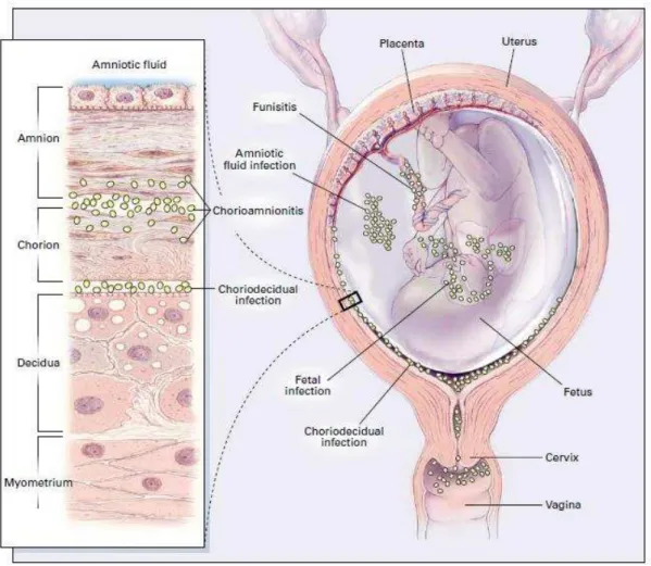 Figure 3 : Sites potentiels de l'infection bactérienne intra-utérine (d'après Goldenberg 2000) 