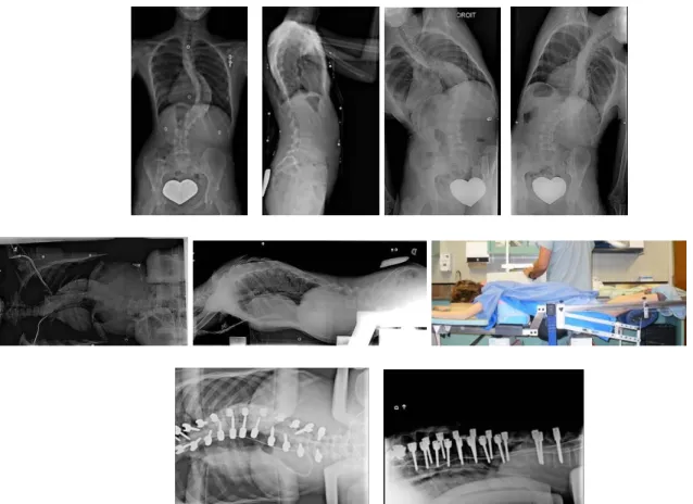 Figure 3.1 (A1F1): Representative radiographs of patient #1 from left to right, top row: PA  standing, lateral standing, left and right standing lateral bending; middle row: PA and lateral on  MFPF with picture of experimental setup; and bottom row: PA and lateral on Relton-Hall frame 