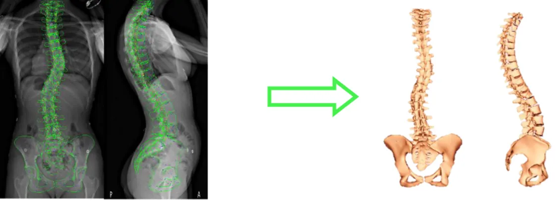 Figure  2.16:  Exemple de reconstruction  géométrique du rachis  et  du bassin avec  IdefX pour un  patient scoliotique (© S.D