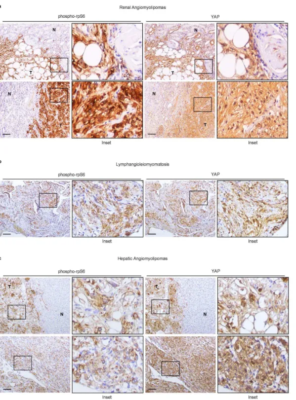 Figure 7.  YAP levels correlates with rpS6 phosphorylation in human TSC-related PEComas