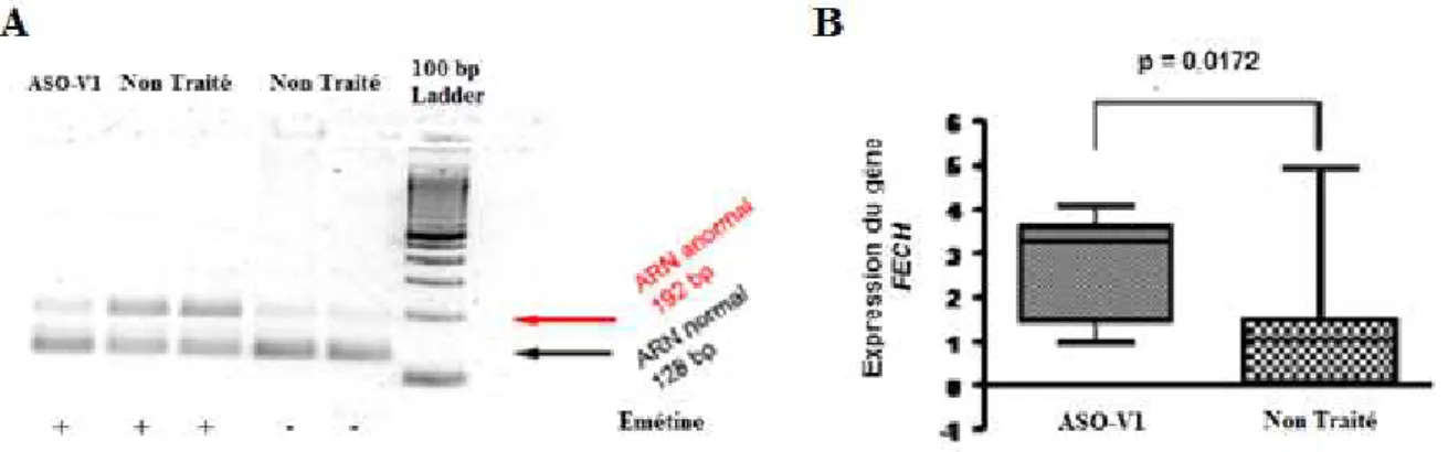 Figure 27)  Effet  d’ASO-V1  transfecté  par  le  lipofectamine  2000  dans  des  lignées  lymphoblastoïdes issues de patients PPE, modifié d’après Oustric et al, 2013  193 