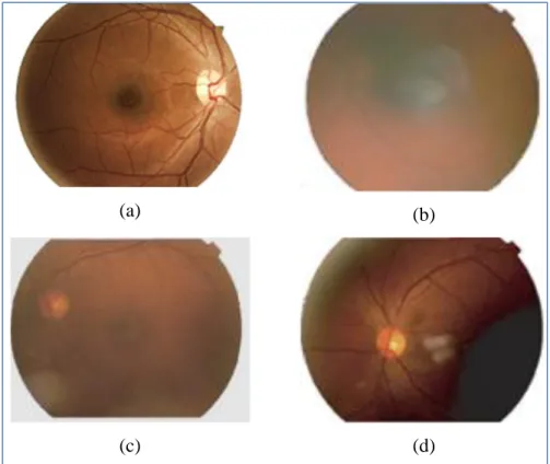 Figure 1.1: Gradable and ungradable retinal images. (a) Gradable, (b) Blur, (c) Low contrast, (d)  Poor visibility of macula region and uneven illumination 