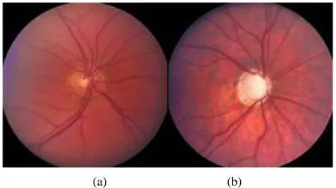 Figure 2.7:  Effect of glaucoma on the optic disc: 