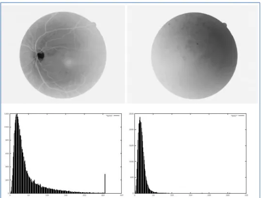 Figure 3.1: Examples of gradable (left) and ungradable (right) retinal images with the  corresponding edge distributions (waiting for permission) [23]  