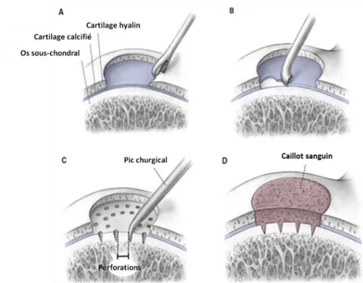 Figure  2.2 :  Étapes  de  la  réparation  du  cartilage  par  stimulation  osseuse.  A  et  B)  Le  cartilage  endommagé  et  la  couche  de  cartilage  calcifiée  sont  d’abord  enlevés