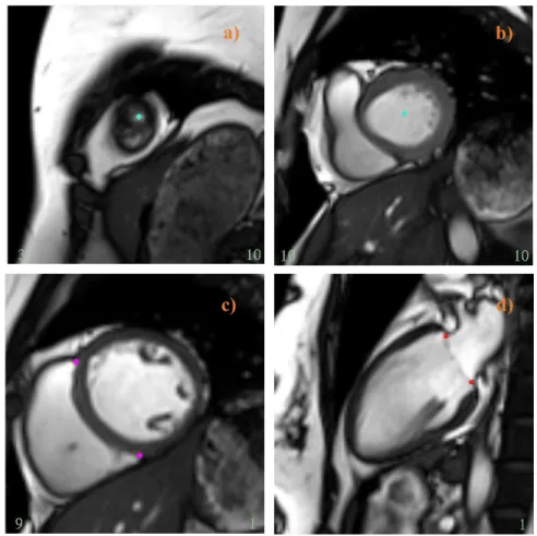 Figure 3.1. Shows the locations of apex point (a), basal point (b), RV insertion points (c), and base  plane points (d) at end-systolic frames on a series of CMR images.