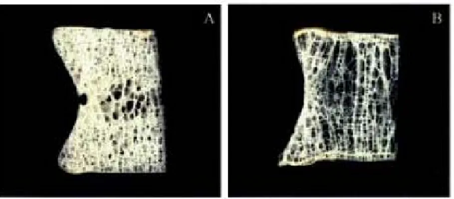 Figure 1.14: vertèbre d'un sujet jeune et d'un sujet plus âgé [41] (image reproduite avec la  permission d’Elsevier) 