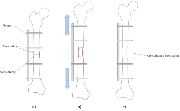 Figure 2.3: Limb lengthening by distraction osteogenesis steps: a) latency phase; b)  distraction/activation phase; c) consolidation phase 