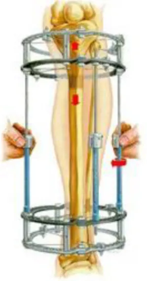 Figure 2.7: Ilizarov ring fixator (Smith&amp;Nephew 2018) 