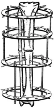 Figure 2.8: Ilizarov ring fixator (Paterson 1990) 