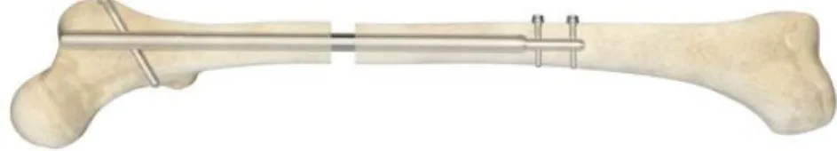 Figure 2.11: Guichet/Albizzia nail (X-os 2014) 