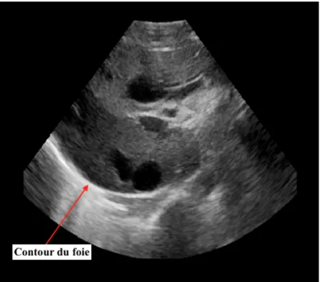 Figure 3.5 Image B-mode du foie illustrant une partie du parenchyme hépatique. La flèche rouge indique une partie du contour du foie qui apparait hyperéchogène (i.e blanches) sur l’image B-mode.