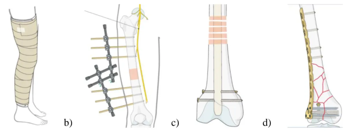 Figure 2.4 : Principaux dispositifs utilisés pendant la guérison de l’os : (a) le plâtre, (b)  les systèmes articulés, (c) les clous intra-médullaires et (d) les plaques (images tirées de 