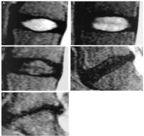 Figure 1-8 : Gradation de la dégénérescence discale par images IRM pondérées en T2 (extrait de  Pfirrmann, 2001)