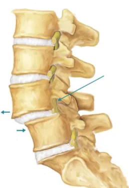 Figure 1-10: Illustration du  spondylolisthésis [1]. 
