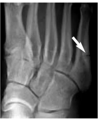 Figure  1.1:  Radiograph  of  a  patient  with  a  nonunion  stress  fracture  of  the  proximal  fifth  metatarsal (demonstrated by an arrow) (Rosenberg &amp; Sferra, 2000) 