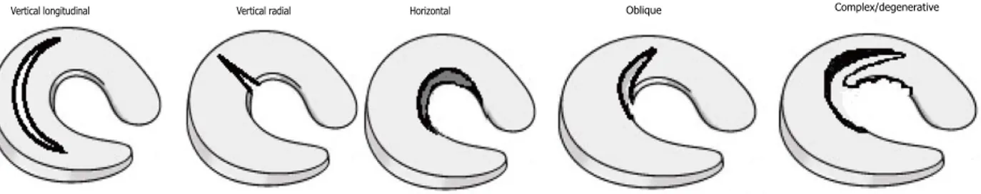 Figure 3.5 Drawing of common types of menisci tears (52). 