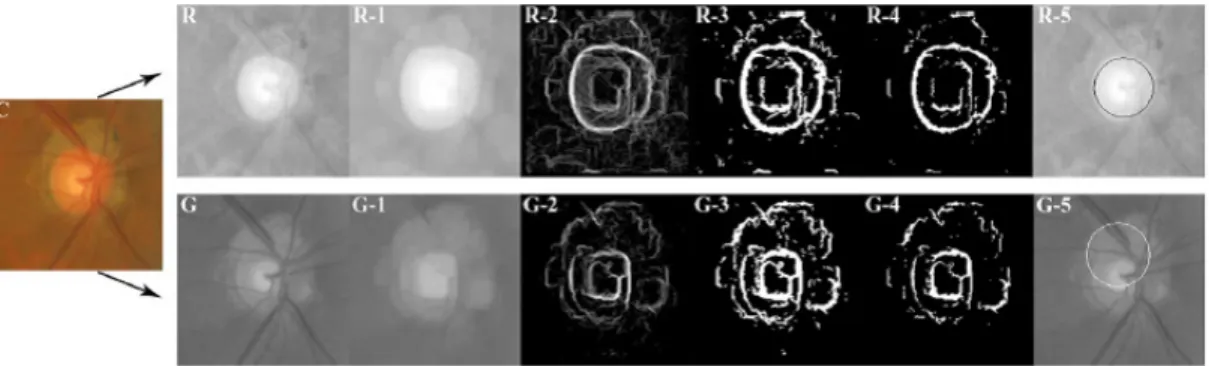 Figure 2.36 R= canal rouge, G=canal vert, RG-1 ; après fermeture morphologique, RG-2-3-4 : gradient, puis binarisation RG-5 : résultat de l’approximation de Hough (Aquino et al., 2010)