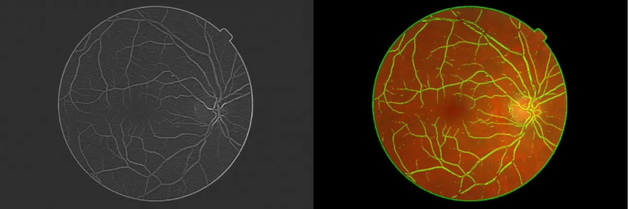 Figure 2.40 A gauche : Filtre optimal gaussien ; à droite : Segmentation des vaisseaux après seuillage