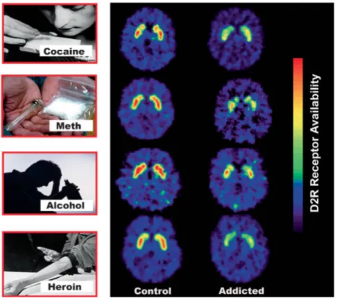 Figure  12:  Disponibilité  des  récepteurs  D2  du  striatum  évaluée en TEP chez des sujets  sains et des sujets dépendants