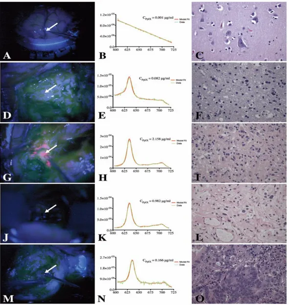 Figure 2-2: Mesures spectroscopiques in vivo de la PpIX induite par 5-ALA durant la chirurgie à  crâne ouvert pour la résection de tumeur au cerveau [5]