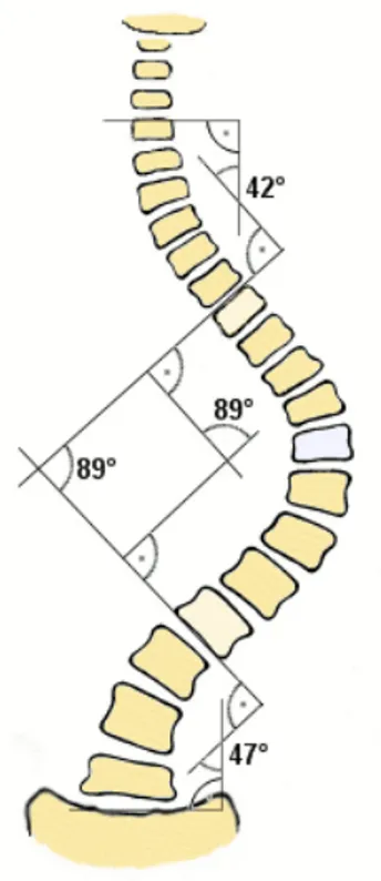 Figure 1 Illustration d’une mesure d’angle de Cobb. Trois angles sont mesurés, une pour chaque courbure de la colonne vertébrale