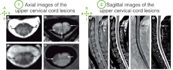 Figure 2.8: Axial and Sagittal views of cervical cord with lesions. 