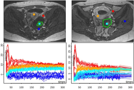 Figure 4.2: Two DCE-MRI image sequences on female pelvis with ovarian tumors - -each column shows one sequence