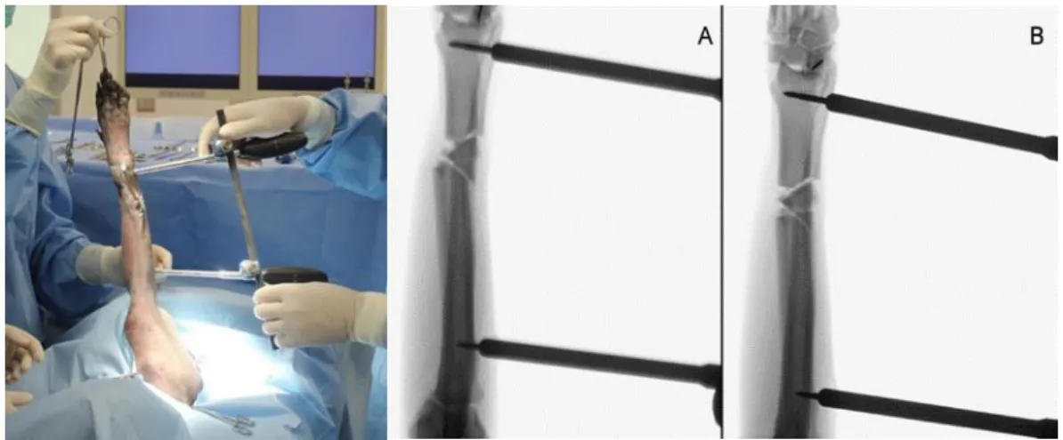 Figure 12 : Photographie obtenue lors de l'application initiale du système d'instrumentation de  réduction minimalement invasive
