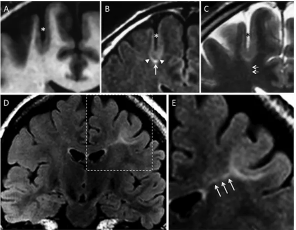 Table 2 Clinical and histological data of positive-MRI and negative-MRI patients 