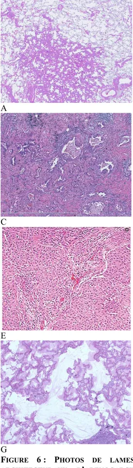 FIGURE  6 :  PHOTOS DE LAMES COLOREES A L’HES DES DIFFERENTS TYPES  ARCHITECTURAUX D’ADENOCARCINOME PULMONAIRE SELON LA CLASSIFICATION  IASLC/ATS/ERS 2011 