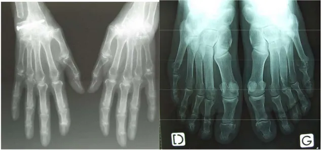 Figure 3 : Destructions articulaires liées à la PR (mains à gauche, pieds à droite) 
