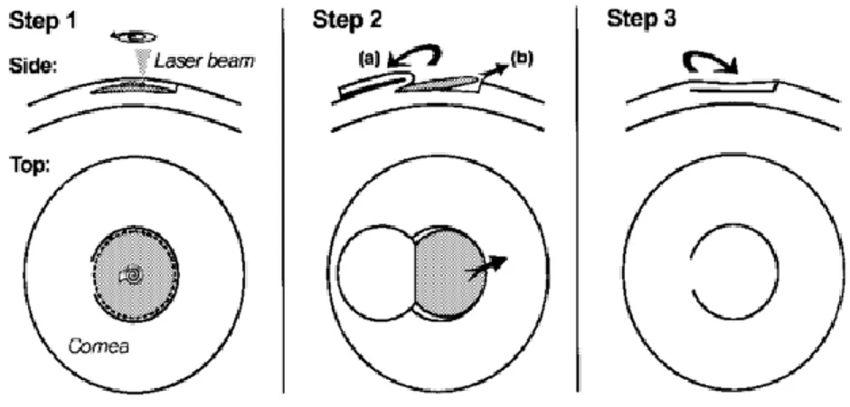 Figure 2.2 Correction de la vue par laser (LASIK). Tiré de [3]. © IEEE, 1999. Reproduction avec  autorisation