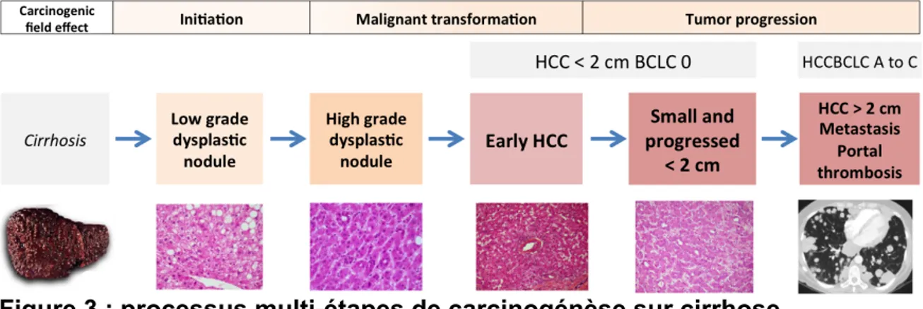 Figure 3 : processus multi-étapes de carcinogénèse sur cirrhose 