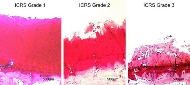 Figure 1- 9 : Sections histologiques provenant de patients ayant subi une arthroplastie totale du  genou en raison d’arthrose